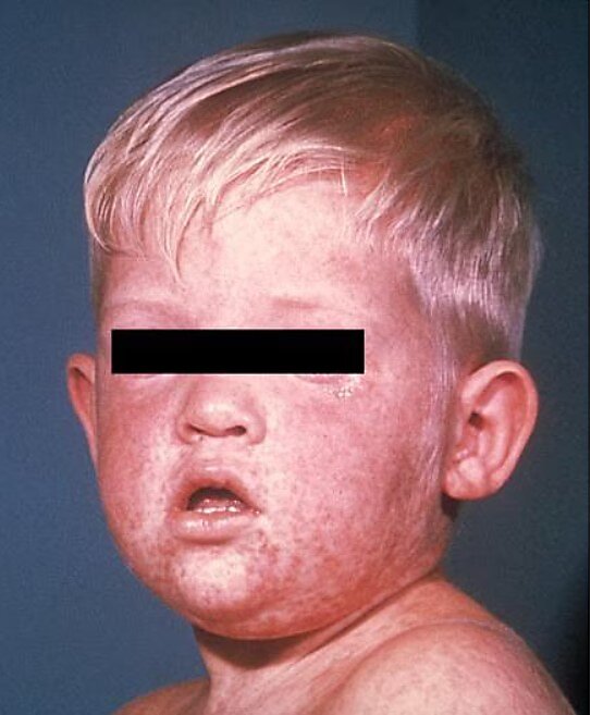 Boy after three days with measles rash